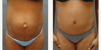 Case 1956 - Woman treated with Tummy Tuck