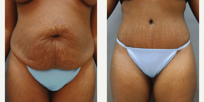 Case 1957 - Woman treated with Tummy Tuck