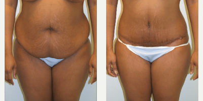 Case 1958 - Woman treated with Tummy Tuck