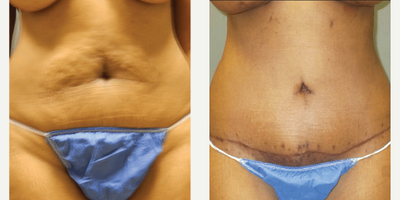 Case 1959 - Woman treated with Tummy Tuck
