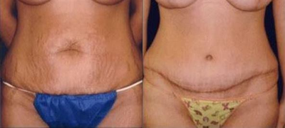 Case 1961 - Tummy Tuck