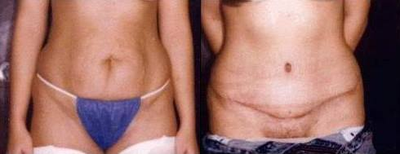 Case 1962 - Tummy Tuck