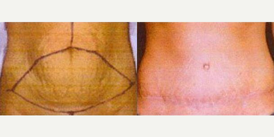 Case 1964 - Tummy Tuck