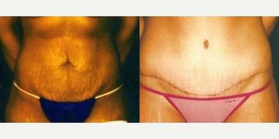 Case 1965 - Tummy Tuck