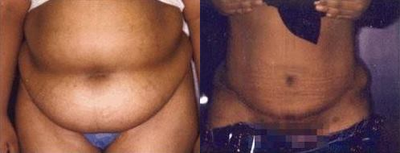 Case 1966 - Tummy Tuck