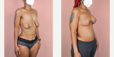 Case 1973 - 25-34 year old woman treated with Tummy Tuck