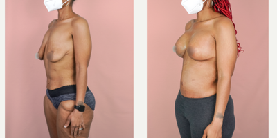 Case 1974 - 25-34 year old woman treated with Tummy Tuck