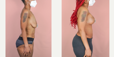 Case 1975 - 25-34 year old woman treated with Tummy Tuck