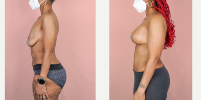 Case 1976 - 25-34 year old woman treated with Tummy Tuck