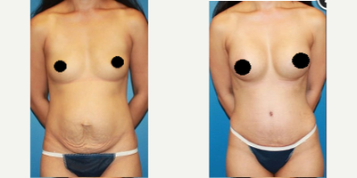 Case 1977 - Woman treated with Tummy Tuck