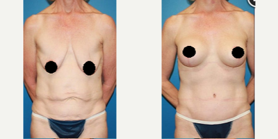 Case 1978 - Woman treated with Tummy Tuck