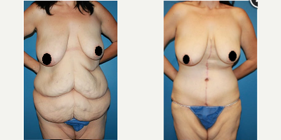 Case 1979 - Woman treated with Tummy Tuck