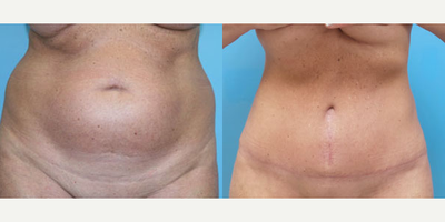 Case 1980 - 55-64 year old woman treated with Tummy Tuck