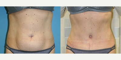 Case 1985 - 45-54 year old woman treated with Tummy Tuck