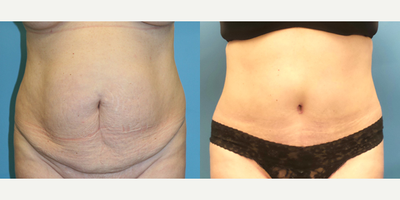 Case 1986 - 45-54 year old woman treated with Tummy Tuck