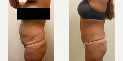 Case 1987 - Woman treated with Tummy Tuck