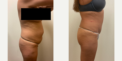 Case 1988 - Woman treated with Tummy Tuck