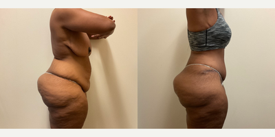 Case 1989 - Woman treated with Liposuction, Tummy Tuck