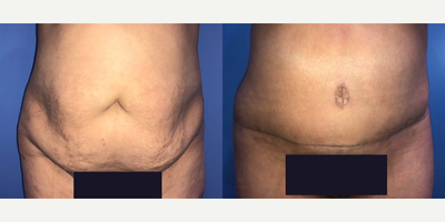 Case 199 - Woman treated with Tummy Tuck