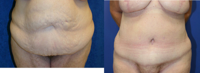 Case 1990 - 55-64 year old woman treated with Tummy Tuck