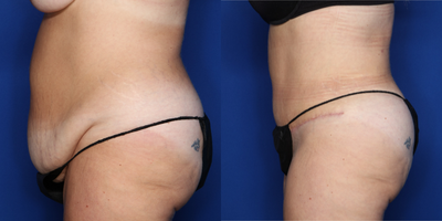 Case 1991 - 45-54 year old woman treated with Tummy Tuck