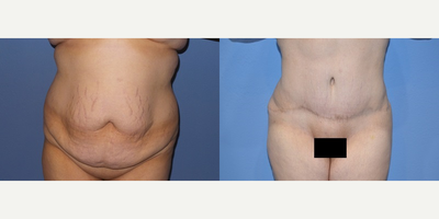 Case 1992 - 25-34 year old woman treated with Tummy Tuck