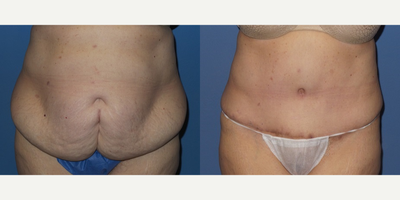 Case 1993 - 55-64 year old woman treated with Tummy Tuck