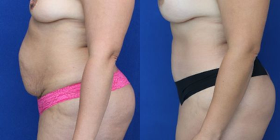 Case 1996 - Tummy Tuck