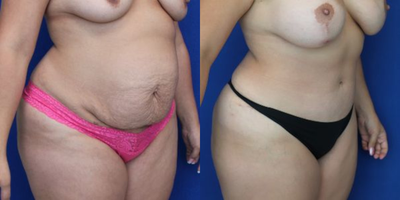 Case 1997 - Tummy Tuck