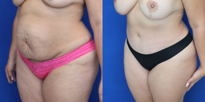 Case 1998 - Tummy Tuck