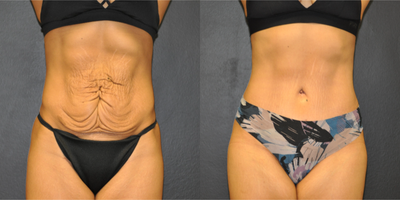 Case 1999 - 32 year old woman treated with Tummy Tuck