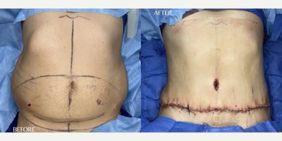 Case: 2 - before and after photo of 39 year old man treated with Tummy Tuck by J. Timothy Katzen, MD, FACS
