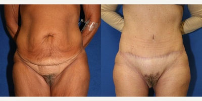 Case 20 - Woman treated with Tummy Tuck