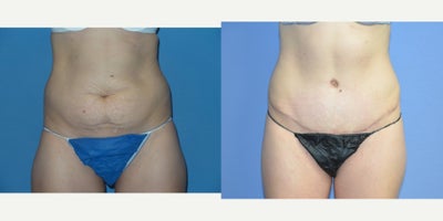 Case 2000 - 25-34 year old woman treated with Tummy Tuck