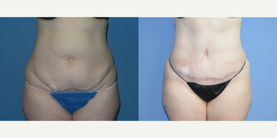 Case 2001 - 35-44 year old woman treated with Tummy Tuck