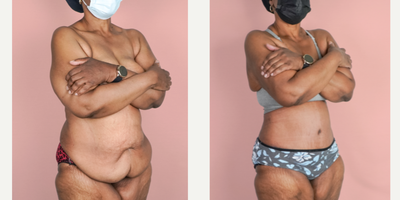 Case 2002 - 55-64 year old woman treated with Tummy Tuck, Tumescent Liposuction