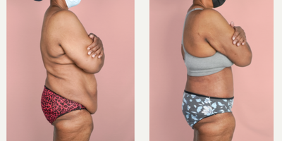 Case 2003 - 55-64 year old woman treated with Tummy Tuck, Tumescent Liposuction