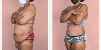 Case 2004 - 55-64 year old woman treated with Tummy Tuck, Tumescent Liposuction