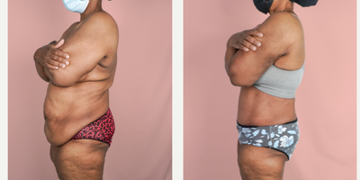 Case 2005 - 55-64 year old woman treated with Tummy Tuck, Tumescent Liposuction