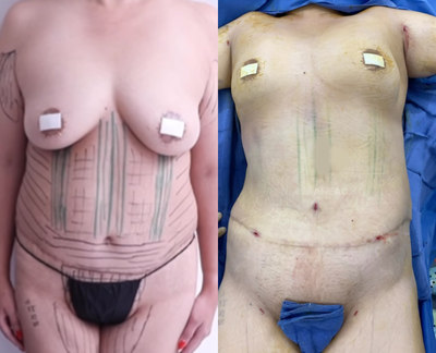 Case 2011 - 45-54 year old woman treated with Liposuction, Vaser Liposuction, Tummy Tuck