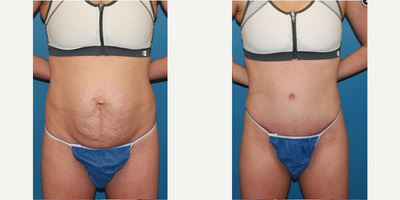 Case 2012 - Woman treated with Tummy Tuck