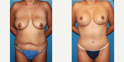 Case 2013 - Woman treated with Tummy Tuck