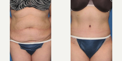Case 2014 - Woman treated with Tummy Tuck