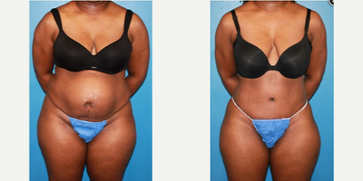 Case 2015 - Woman treated with Tummy Tuck