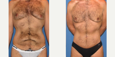 Case 2017 - Man treated with Tummy Tuck