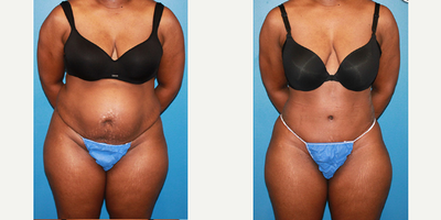 Case 2018 - Woman treated with Tummy Tuck