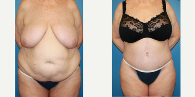 Case 2019 - Woman treated with Tummy Tuck