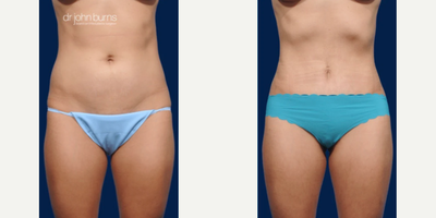 Case 202 - Woman treated with Tummy Tuck