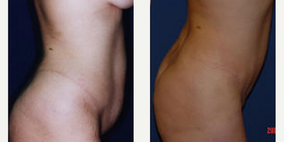 Case 2020 - Woman treated with Tummy Tuck