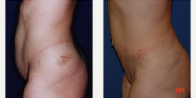 Case 2021 - Woman treated with Tummy Tuck